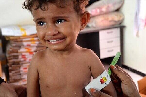 بدترین بحران انسانی جهان در یمن؛ سوء تغذیه هزاران کودک در جریان جنگ ۵ ساله