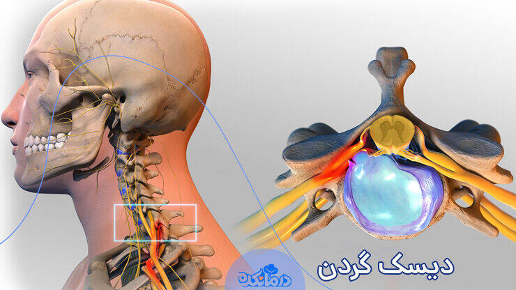 علائم و روش‌های درمان دیسک گردن