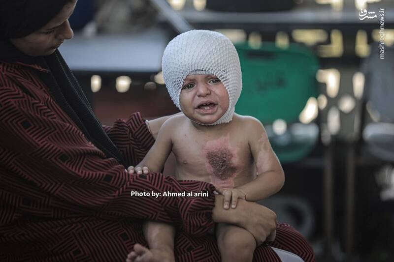 عکس/ اثر آتش کینه صهیونیست‌ها بر روی بدن کودک فلسطینی