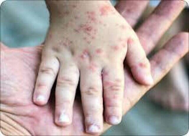 لزوم ایمنی مادران باردار در برابر آبله‌مرغان / اهمیت واکسیناسیون قبل از بارداری